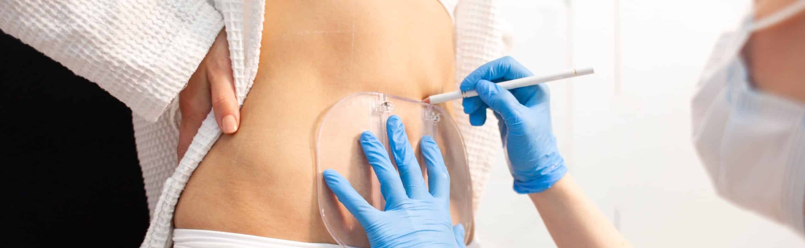 Avis cryolipolyse